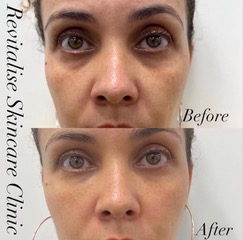Before and after picture for hollow under eyes
